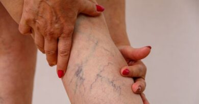 Side Effects of Varicose Veins Treatment 